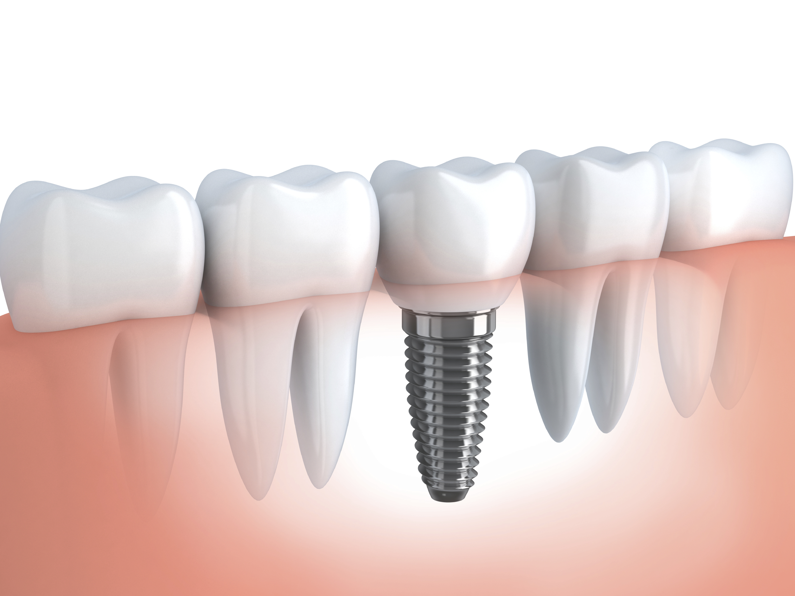 How Many Teeth Can Dental Implants Support, St. Charles?