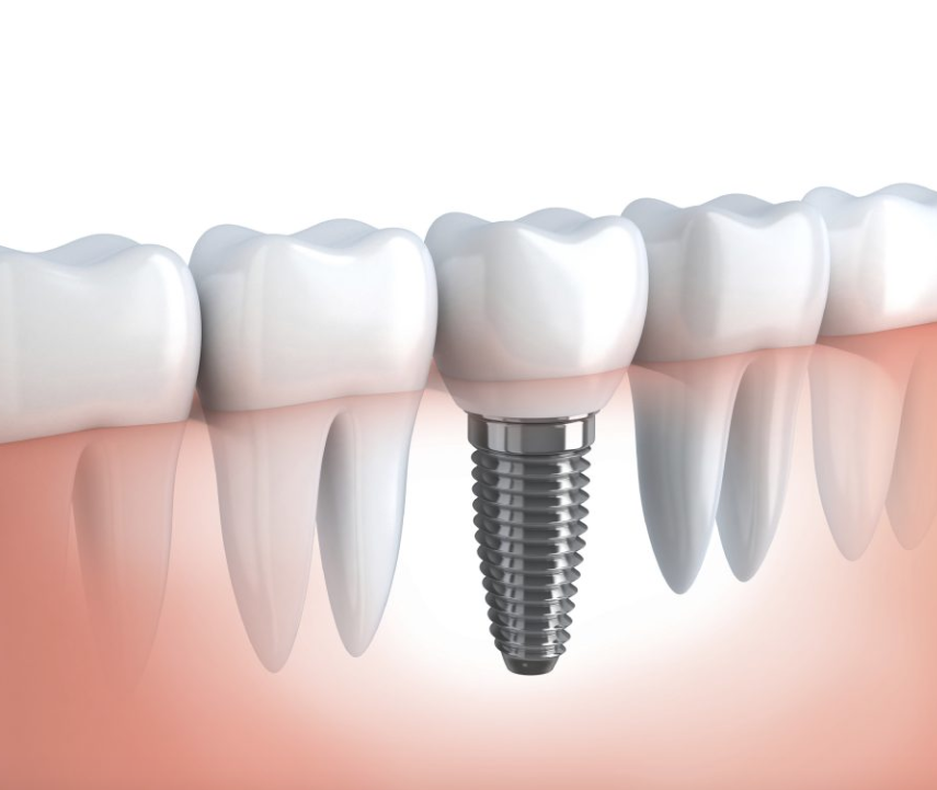 Things to Expect During a Dental Implant Procedure – Wilton Manors, FL