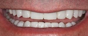 upper and lower teeth after porcelain veneers procedure