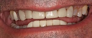 upper and lower teeth before porcelain veneers procedure