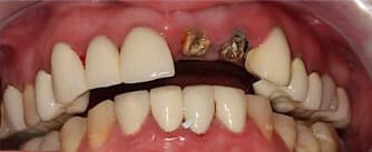 before dental implants and EMAX crown procedures